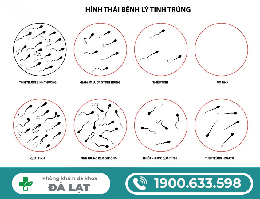TINH TRÙNG LOÃNG LÀ GÌ TINH TRÙNG LOÃNG CÓ CON ĐƯỢC KHÔNG?